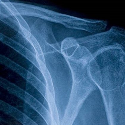 X-ray image of shoulder